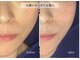 セレーノ 白金台(seReno)の写真/#韓国脂肪分解【レモンボトル】結果×持続◎見違える程フェイスラインが整う。ダウンタイム/リバウンドなし