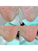 巻き爪補正店 市川駅前店/ 角質ケア