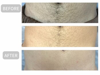 フルーブラン(Frubran)/【メンズ全身脱毛】つるすべ肌へ