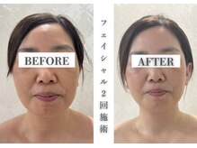 リアレント 高槻店(Lialent)の雰囲気（糸リフト級の仕上がりに｜リフトアップ｜小顔｜美肌｜艶肌）