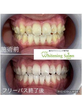 ホワイトニングサロン 札幌店/【ホワイトニング】#札幌#大通り
