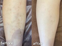 サージュクロレ 松戸店(sage colorer)/クリスタルハーブピーリング(体)