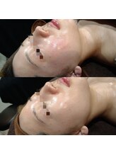 ボーソリューション(Beau-Solution)/【20代　赤みニキビケア】