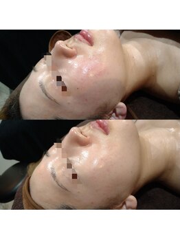 ボーソリューション(Beau-Solution)/【20代　赤みニキビケア】