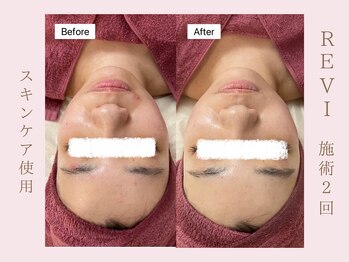 ルア(LuA.)/肌荒れ改善◎