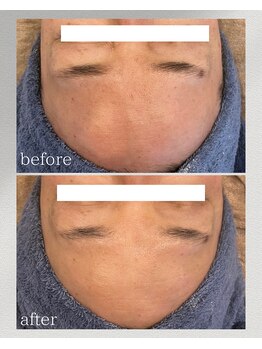 カリス(charis)/くすみ改善