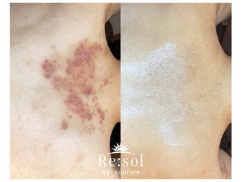 リソルバイスリール(Re:sol by sourire)/Re:sol ハーブピーリング専門店