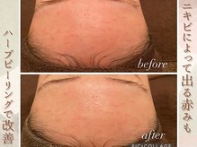 ラナ(LaNa)/おでこの乾燥こじわ改善ハーブ