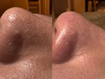 サラグランデ(Sara Grande)/黒ずみ角栓ごっそり回収します!