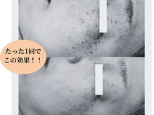 ソイ(Soi)/たった1回で驚きの変化！