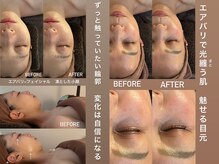 アンミー(anmiiy)の雰囲気(小顔・たるみはエアバリで瞬間リセット!変化はフォトへ♪)