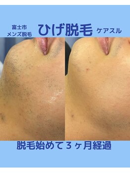 ケアスル 富士店/ひげ脱毛 メンズ脱毛