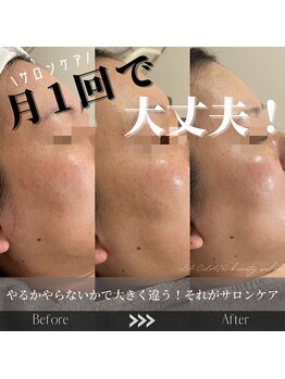 ラ クレール ビューティーサロン(LA CLAIR)/エンビロンAHAピーリング