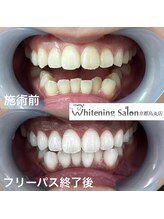 ホワイトニングサロン 京都烏丸店/ホワイトニング施術例