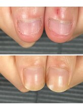 ルカロンネイル(Rukaron Nail)/むしり爪