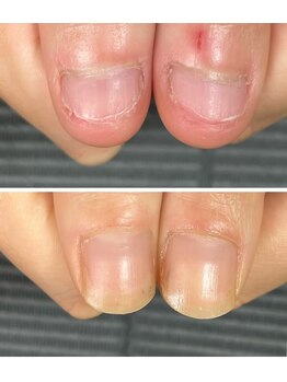 ルカロンネイル(Rukaron Nail)/むしり爪