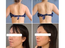 インディバサロン テスタ(testa)の雰囲気（上→インディバ+筋膜リリース(１回)　　下→インディバ(１回)）