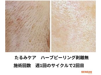 洗顔サロン 池袋(SENGAN)/たるみケア　剥離無