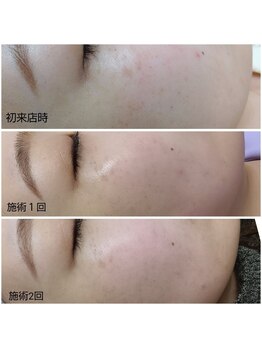 ハクア(HAQUA)/シミケア/フェイシャル/三ノ宮