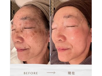 シンデレラ しみケア(Cinderella)/シミケアプログラム