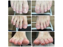 ミコ(.mico)の雰囲気（爪の脱落、義爪作成可能。）