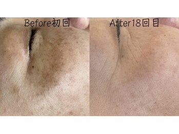 エリア(area.)/7、【シミケア35分】