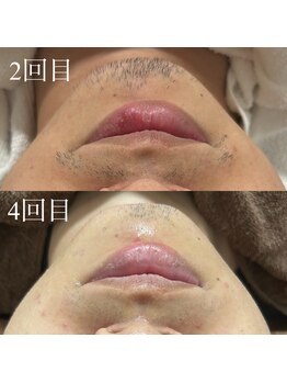 ランプ(LAMP)/~ハイブリッドヒゲ脱毛~