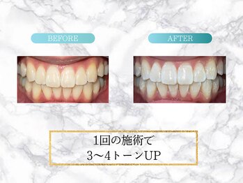 ロイヤル(ROYAL)/【ホワイトニング】before/after