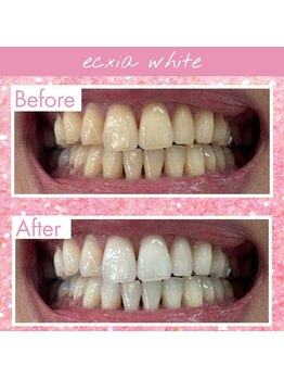 エクシアホワイトフジ(ecxia white fuji)/ホワイトニングビフォーアフター