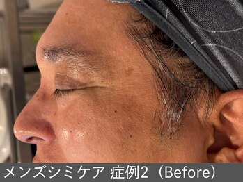 オアシスラグーン(OASIS LAGOON)/メンズシミケア(症例2 before)