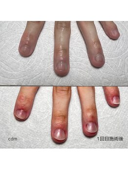 シーディーエム ジュエ(cdm jouer)/深爪でお悩みの方に