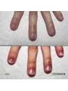 深爪でお悩みの方に