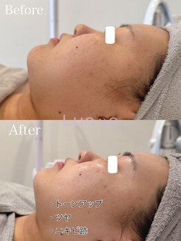 ルノン(Lunon)/毛穴洗浄ハイドロ×ララピール