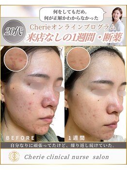 シェリー(Cherie)/施術なし！繰り返すニキビ終了
