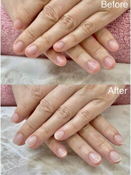 ビアン(Bienvenue)/深爪矯正