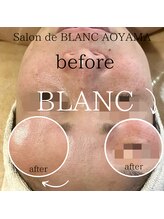 サロン ド ブラン アオヤマ(Salon de BLANC AOYAMA)/BLANC式小顔/水艶肌ソノケア