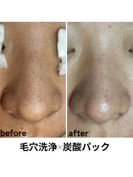 ルアナ 北谷店/毛穴洗浄毛穴ケア 《沖縄/北谷》