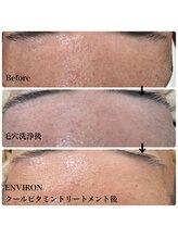 モスト(MOST)/毛穴洗浄＆エンビロンエステ