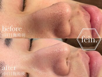 フェイン 青山店(fein.)/ハーブピーリングで毛穴のお掃除