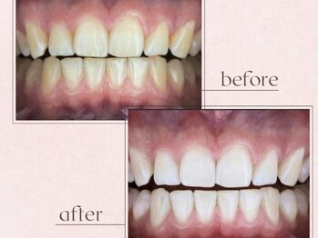 ルアナシンフォニア エクシア 池袋店(Luana-Sinfonia)/ホワイトニングビフォーアフター