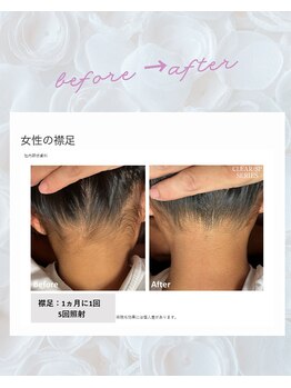 ノノ(nono)/うなじ～えりあし脱毛