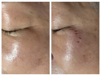 エステサロン オパール(OPALE)/宮崎でシミケアすらなら！