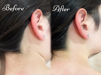 ピミル(PIMIL)/うなじ脱毛