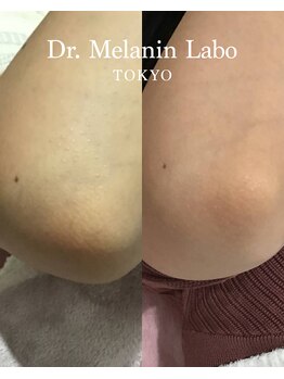 ドクターメラニン ラボ トーキョー 渋谷(Dr. Melanin Labo TOKYO)/肘メラニンケア症例