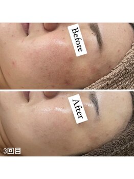 カルディエ(Cardie)/肌質改善　ビフォーアフター