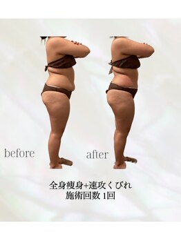 カリス(charis)/全身痩身　初回体験