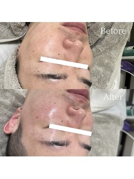 ラ フルール(La Fleur)/カーボキシートリートメント