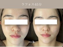 リィ プラス(Riii plus)/【シャープなフェイスライン】