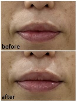 プロッソル こころ(PROSOL)/【NEW】光フェイシャル