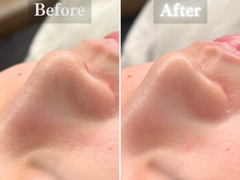 ボーンオム(Born Homme)/毛穴洗浄＋美容液導入：20代女性